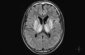 irm encéphalique