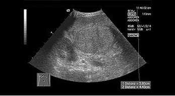 Echographie hépatique