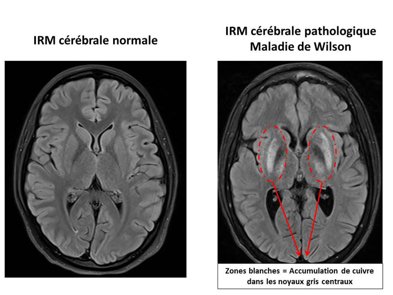 IRM Cerebrale